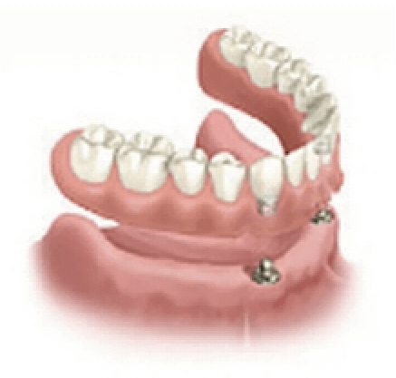 インプラントと総入れ歯が実現する安定した噛み応え