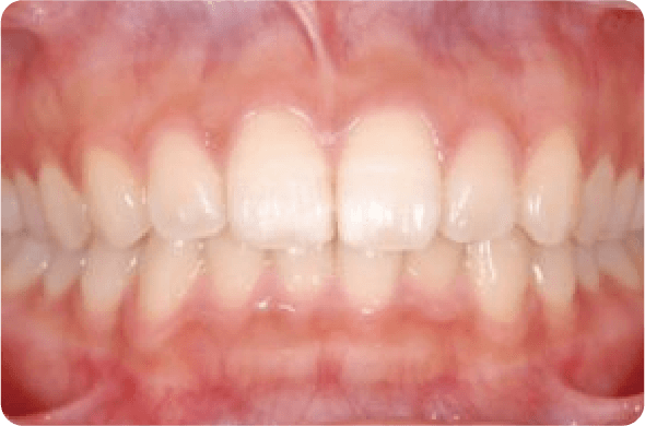 上下の前歯の歯と歯の間に1～2mm程度の隙間がありますか？