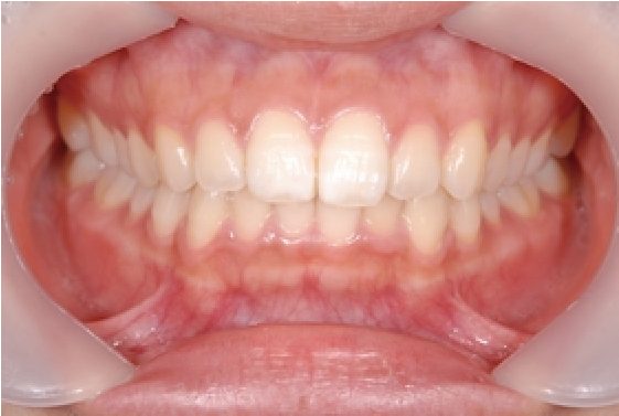 虫歯と歯周病のコントロール